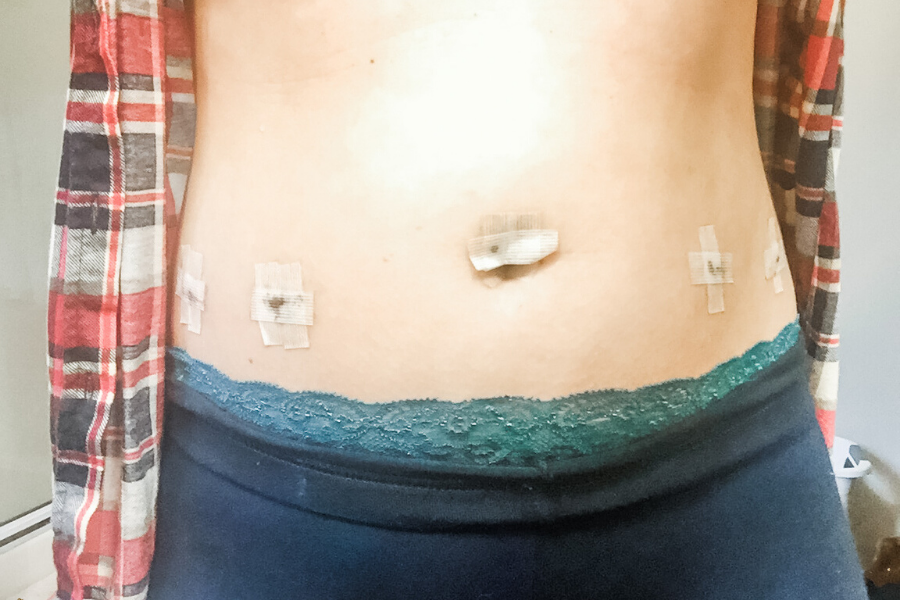 woman post endometriosis surgery showing belly